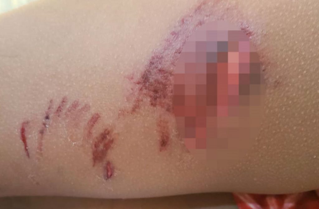 El niño de siete años tiene heridas de consideración en una pierna. Foto: LA PATRIA.