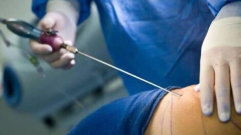 negligencia médica en mini lipo realizada por odontóloga prófuga