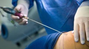 Joven afectada por mini lipo negligencia médica