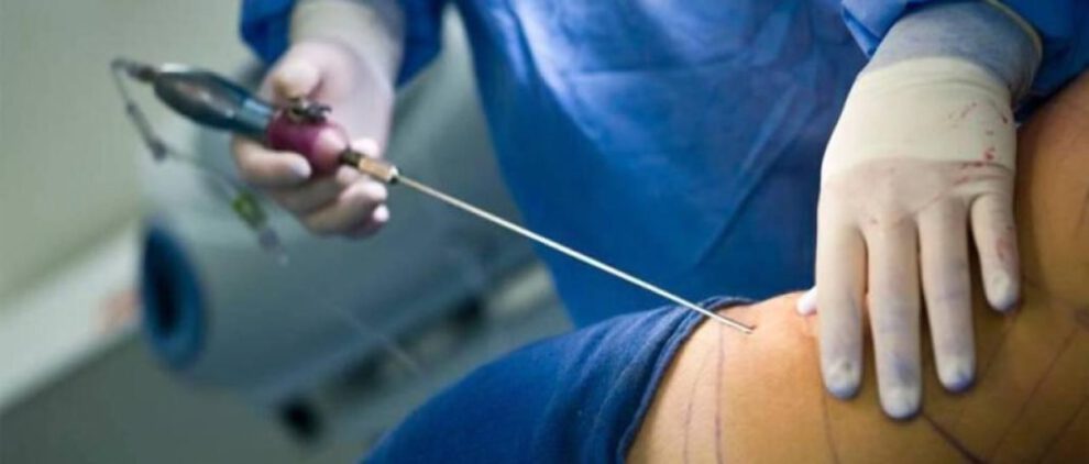 Joven afectada por mini lipo negligencia médica