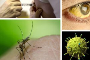 fiebre amarilla es una enfermedad vírica aguda y hemorrágica