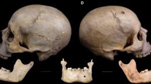Cirugía oncológica en Egipto hace más de 4.000 años