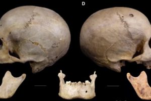 Cirugía oncológica en Egipto hace más de 4.000 años