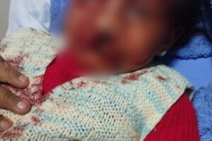 Estado de salud de niña atacada por rottweiler mejora tras exitosa operación