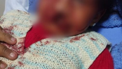 Estado de salud de niña atacada por rottweiler mejora tras exitosa operación