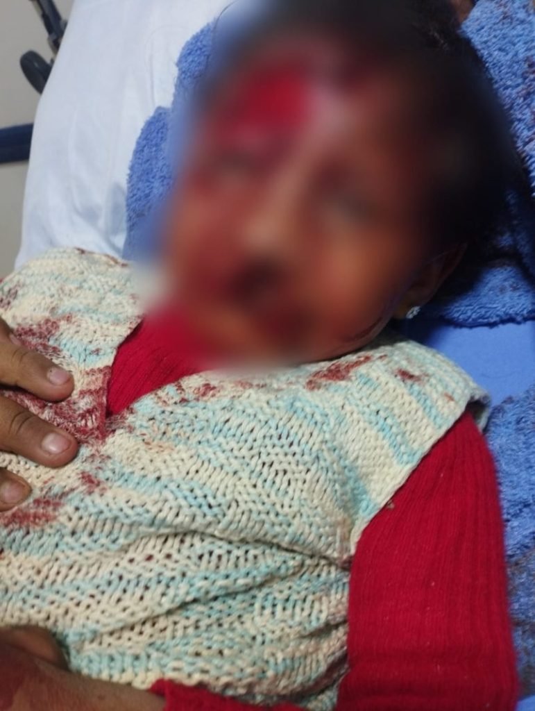 Estado de salud de niña atacada por rottweiler mejora tras exitosa operación