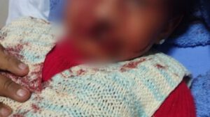 Estado de salud de niña atacada por rottweiler mejora tras exitosa operación