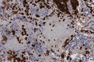 medicamento experimental contra el cáncer para tratar Covid-19