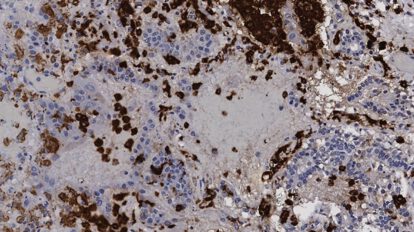 medicamento experimental contra el cáncer para tratar Covid-19