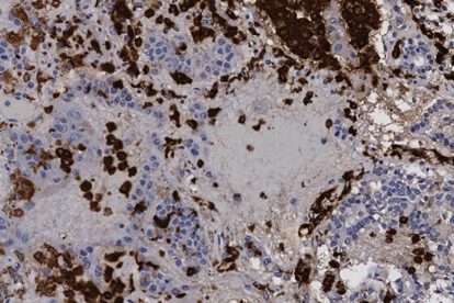medicamento experimental contra el cáncer para tratar Covid-19