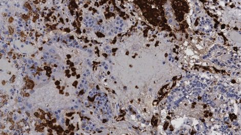 medicamento experimental contra el cáncer para tratar Covid-19