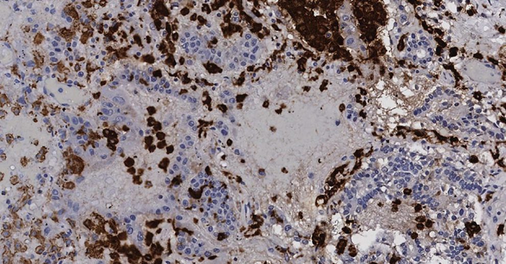 medicamento experimental contra el cáncer para tratar Covid-19