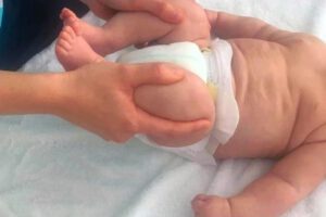 detección de displasia de cadera para infantes