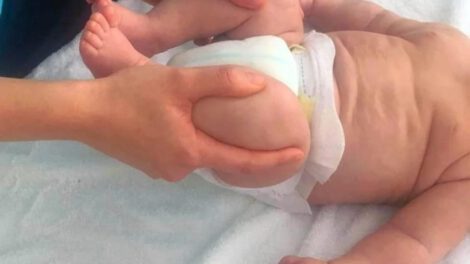 detección de displasia de cadera para infantes