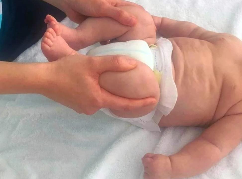 detección de displasia de cadera para infantes