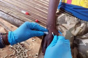 Viruela símica o mpox