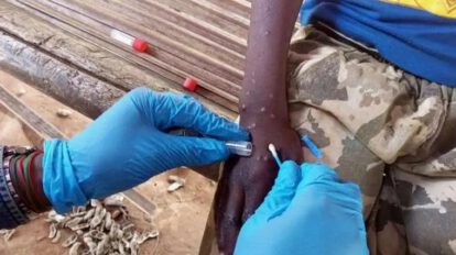 Viruela símica o mpox