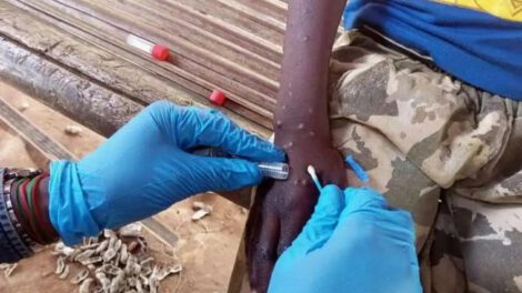 Viruela símica o mpox