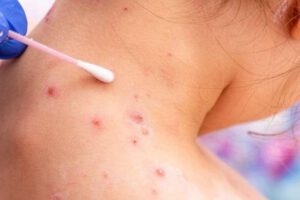 emergencia sanitaria viruela del mono en Oruro