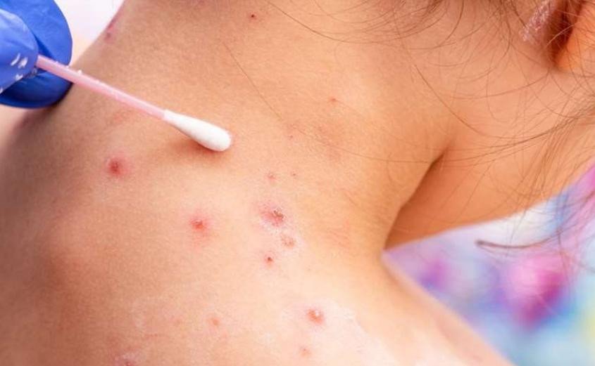 emergencia sanitaria viruela del mono en Oruro