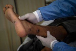 Un médico revisa a un paciente con llagas causadas por una infección de viruela del mono