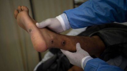 Un médico revisa a un paciente con llagas causadas por una infección de viruela del mono