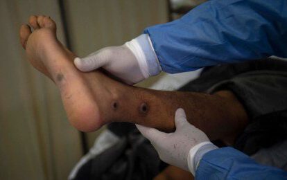 Un médico revisa a un paciente con llagas causadas por una infección de viruela del mono