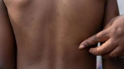 Alerta por primer caso de mpox en Filipinas