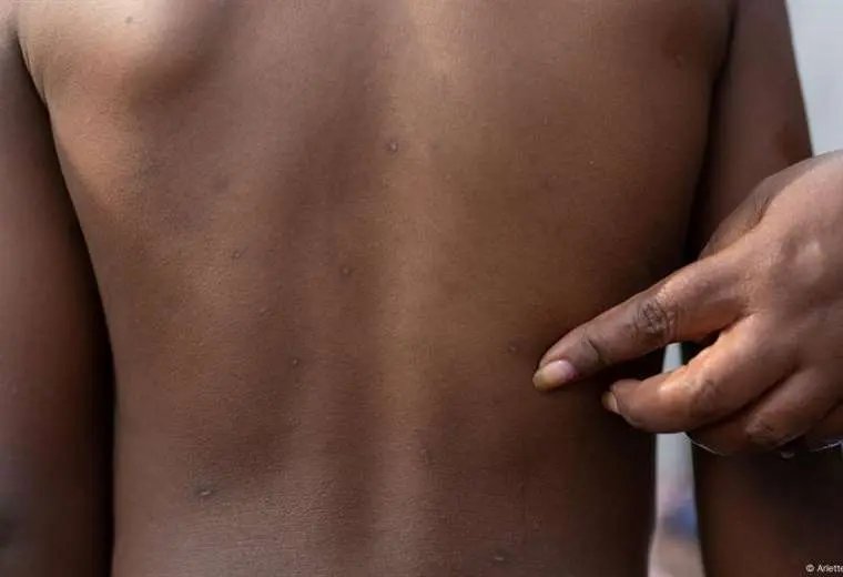 Alerta por primer caso de mpox en Filipinas