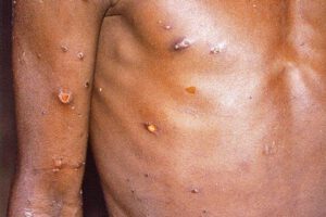 Alerta en Cochabamba por posible caso de viruela del mono