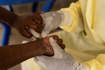 mpox en África