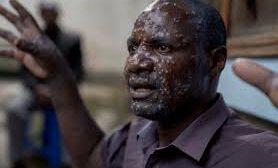 mpox en África
