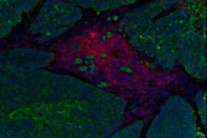 Inmunoterapia STAb-TIL fortalece defensas naturales contra el cáncer