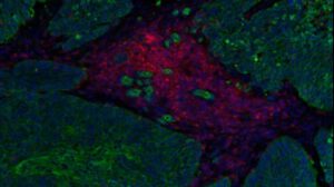 Inmunoterapia STAb-TIL fortalece defensas naturales contra el cáncer