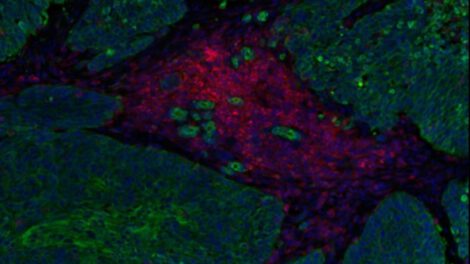 Inmunoterapia STAb-TIL fortalece defensas naturales contra el cáncer
