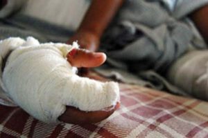 Dos hermanos sufren quemaduras tras confundir gasolina con aceite al cocinar en casa