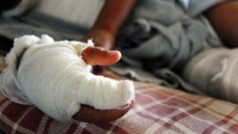 Dos hermanos sufren quemaduras tras confundir gasolina con aceite al cocinar en casa