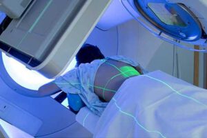 Radioterapia y cáncer de mama