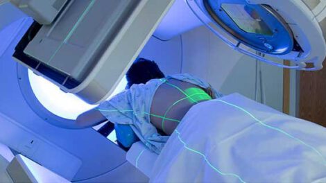 Radioterapia y cáncer de mama