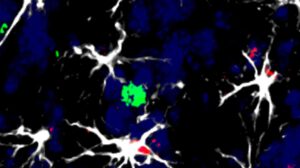 Identifican células que favorecen la metástasis cerebral