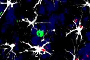 Identifican células que favorecen la metástasis cerebral