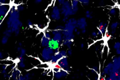 Identifican células que favorecen la metástasis cerebral