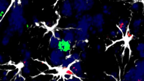 Identifican células que favorecen la metástasis cerebral
