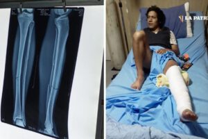 Jhery Choque doble fractura tras cirugía exitosa