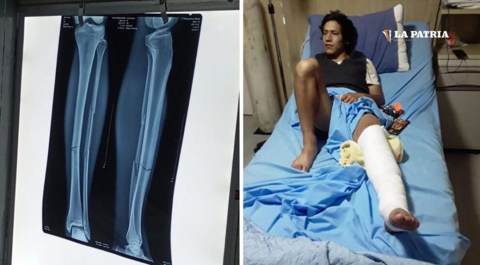 Jhery Choque doble fractura tras cirugía exitosa