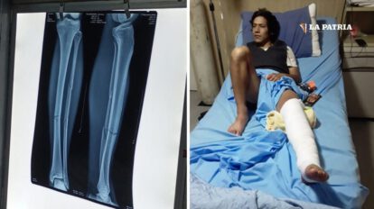 Jhery Choque sufre doble fractura tras duro golpe