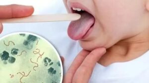 Alerta sobre brote de Streptococcus pyogenes en Cochabamba