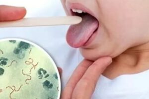 Alerta sobre brote de Streptococcus pyogenes en Cochabamba