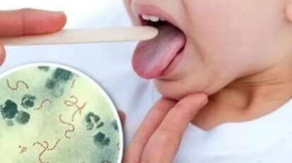Alerta sobre brote de Streptococcus pyogenes en Cochabamba