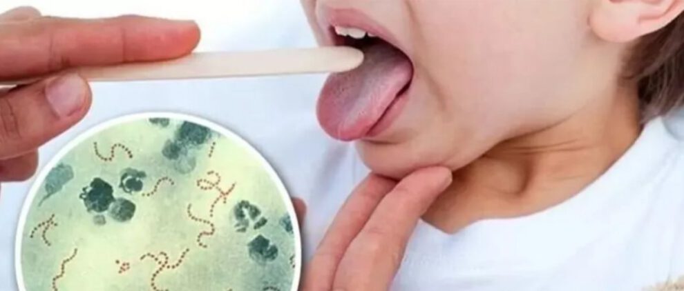 Alerta sobre brote de Streptococcus pyogenes en Cochabamba